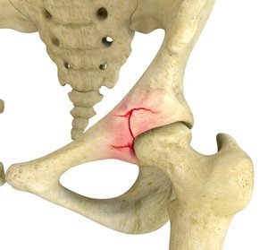 Acetabular Fracture pic