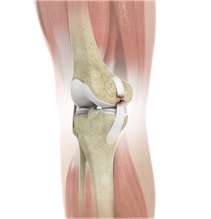 Knee Ligament Injuries pic