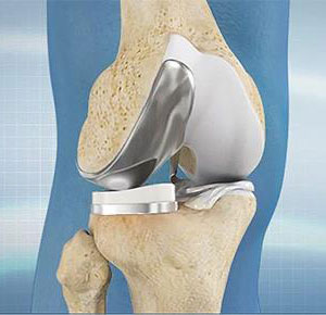 Mako SmartRobotics for Partial Knee Replacement pic