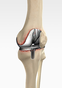 Revision Total Knee Replacement pic