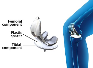 Total Knee Replacement pic
