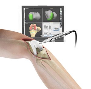 Computer Navigated Joint Replacement pic