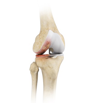Osteoarthritis pic