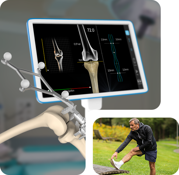Knee Joint Replacement Img