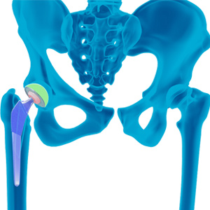 Robotic Assisted Hip Replacement