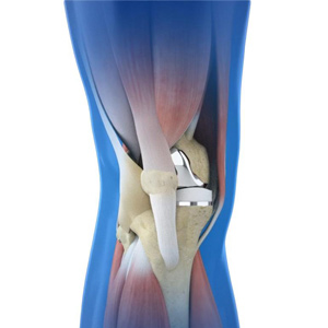 Robotic Assisted Knee Replacement