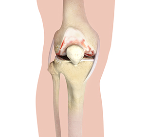 Knee Arthritis Education