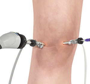 Knee Arthroscopy - Rebecca Griffith, MD