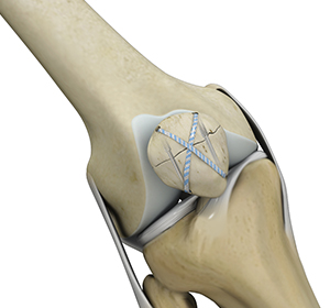 Knee Fracture Surgery - Rebecca Griffith, MD