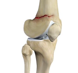 Knee Fracture Education