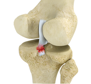 Knee Fracture Education