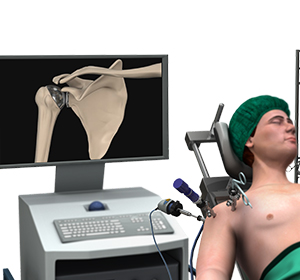 Minimally Invasive Shoulder Joint Replacement Img