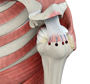 Rotator Cuff Repair
