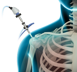 Shoulder Arthroscopy Image