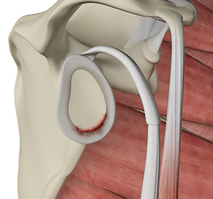 Shoulder Labral Tear Img