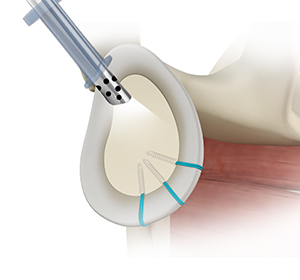 Shoulder Reconstruction Surgery Img