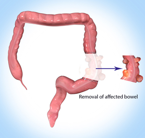 Colon & Rectal Cancer pic