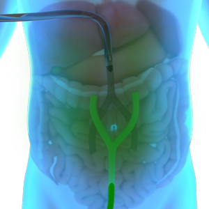 Hyperthermic Intraperitoneal Chemotherapy (HIPEC) pic