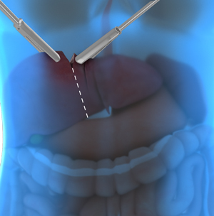 Laparoscopic Liver Resection pic