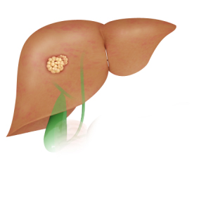 Liver Cancer pic