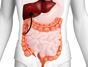 Management of Colon and Rectal Cancer Liver Metastasis pic