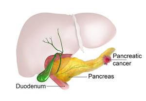 Pancreatic Cancer pic