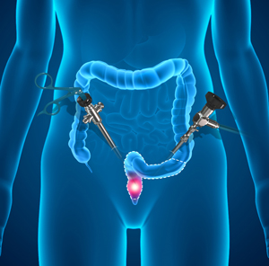 Rectal Cancer Surgery pic