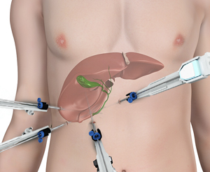 Robotic Cholecystectomy pic