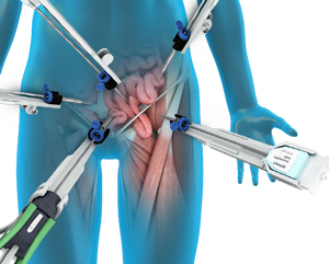 Robotic Hernia Repair pic