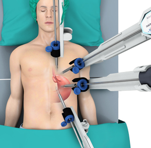 Robotic Hiatal Hernia Repair for Acid Reflux pic