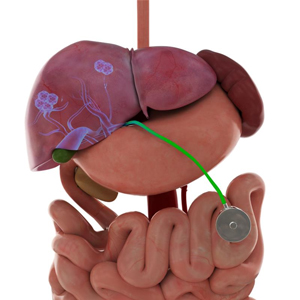 Hepatic Artery Infusion Pump pic