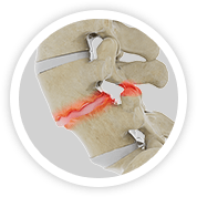 Degenerative Spondylolisthesis