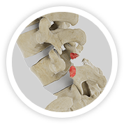 Isthmic Spondylolisthesis