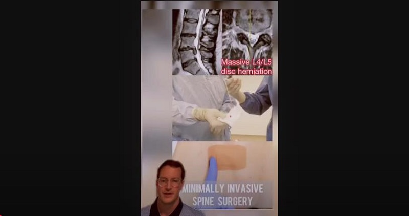 Videos - Why minimally invasive spine surgery￼