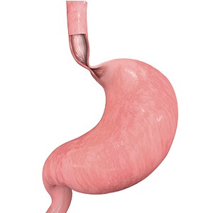 Picture of Achalasia