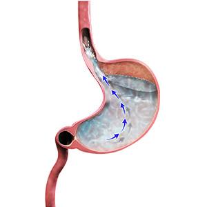 Picture of Acid Reflux