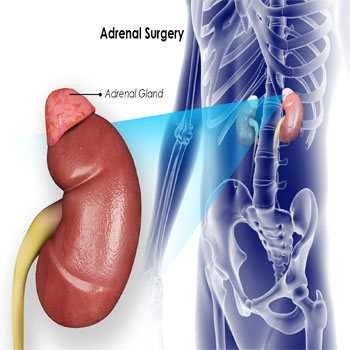Picture of Adrenal Surgery