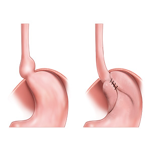 Picture of Anti-Reflux and Esophageal Surgery