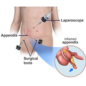 Picture of Appendectomy