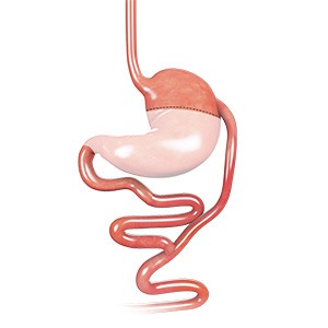 Picture of Biliopancreatic Diversion