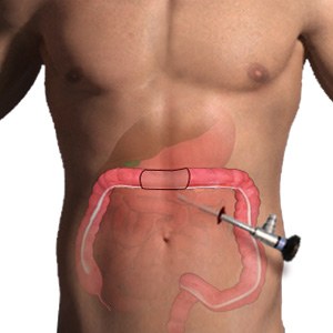 Picture of Colectomy