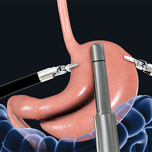 Picture of Endoscopic Sleeve Gastrectomy