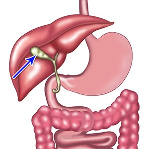 Picture of Gallbladder Disease