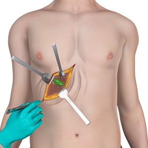 Picture of Gallbladder Surgery
