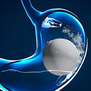 Picture of Gastric Balloon