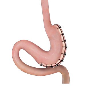 Picture of Gastric Plication