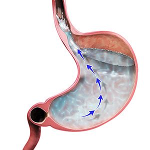 Picture of Gastroesophageal Reflux Disease (GERD)