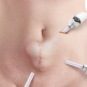 Picture of Hernia Repair