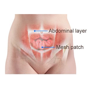 Picture of Incisional Hernia Repair