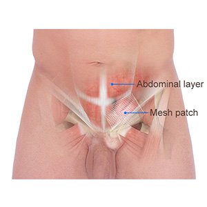 Picture of Inguinal Hernia Repair